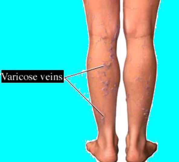 Are Varicose Veins Dangerous